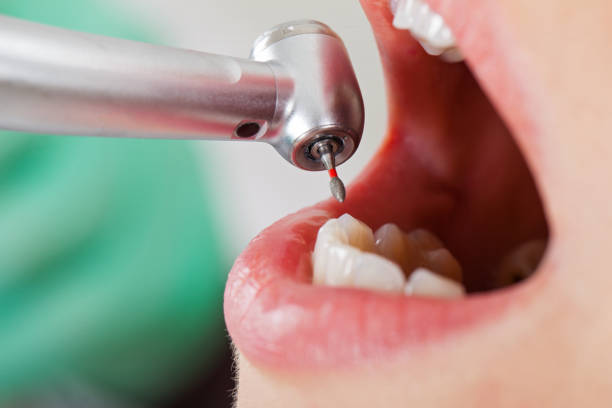 Best Emergency Dental Extractions in Ddleville, MI